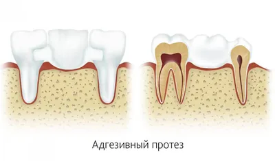 Временные коронки и протезы на зубные имплантаты