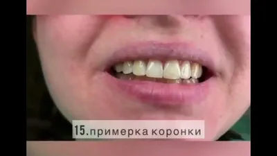 Временные пластмассовые коронки на передние жевательные зубы в  стоматологической клинике Комфорт в Одинцово