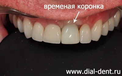 Протезирование переднего зуба на импланте