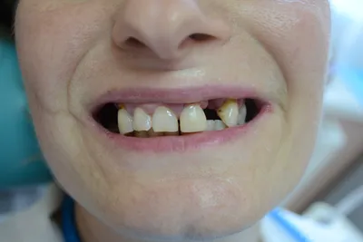 Временный протез на передний зуб Сумы