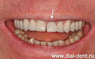 Протезирование переднего зуба на импланте