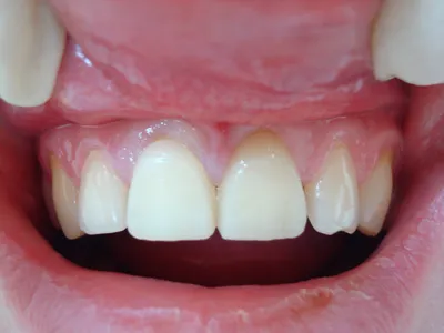 Виды временных зубных протезов