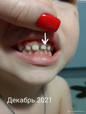 Коронки для молочных зубов Ezcrown Для непрямой реставрации - «Коронки на  молочные зубы трехлетнему ребёнку: моё мнение как потребителя. Что делать,  если от молочного зуба остались только \"пеньки\"? Почему нельзя удалять такие