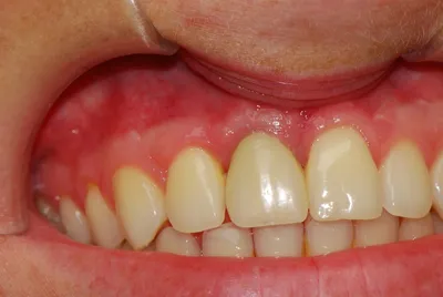 Временные пластмассовые коронки на передние жевательные зубы в  стоматологической клинике Комфорт в Одинцово
