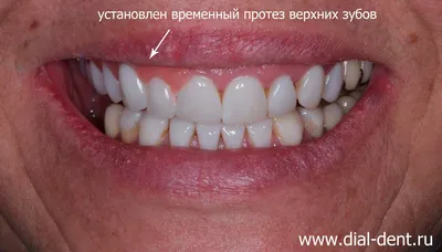 Временный бюгельный зубной протез после имплантации зубов