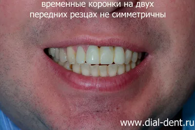 Протезирование передних зубов после имплантации в неправильном прикусе –  исправление чужих ошибок