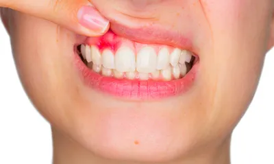 Лечение десен в Москве в стоматологии Face Line
