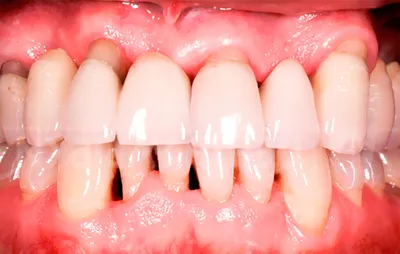 Пародонтоз лечение (причины, симптомы) | Как развивается - центр  стоматологии «Тихонова» в Туле