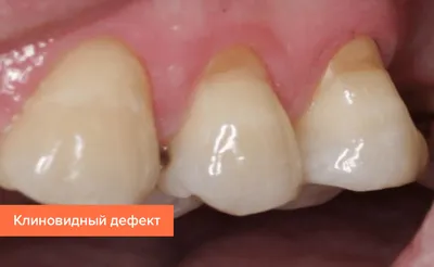 Болезни зубов у человека: названия, фото, симптомы