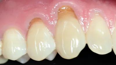 Некариозные поражения зубов: классификация до и после прорезывания