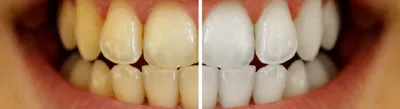 Причины потемнения зубов — новости и статьи Refformat