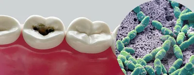 S.Mutans - как эти бактерии вызывают кариес и как этого избежать  Стоматология Dental Way в Москве и Московской области | Dental Way