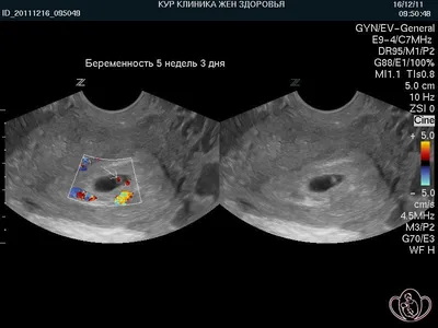 Обвитие пуповиной при беременности — причины, диагностика и риски.