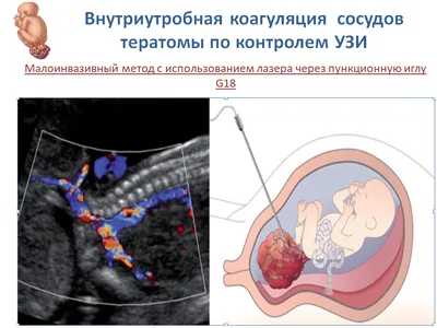 Плановые роды до 39 недель: Стоит ли это делать? - Иркутский городской  перинатальный центр имени Малиновского М.С.