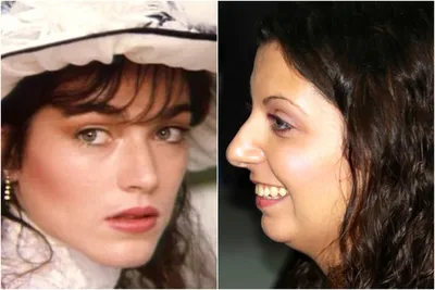 Алена Хмельницкая до и после аппаратного омоложения лица: фото и описание  процедуры | Allure | Glamour