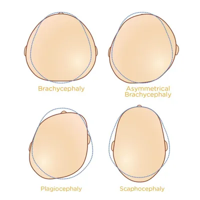 Нарушение симметрии черепа (плагиоцефалия, брахицефалия)