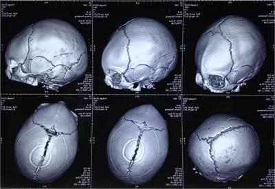 Деформация черепа подавляет рост мозга у ребёнка. Нужно срочно провести  операцию, пока повреждения не стали необратимыми! | Алёша —  благотворительный фонд | Дзен