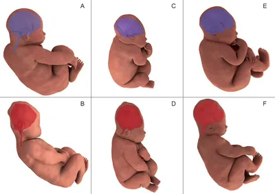 Как меняется череп младенца во время родов