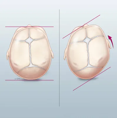 Деформация черепа у младенцев