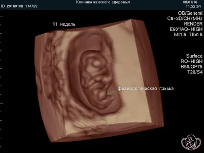 3D УЗИ беременности: показания к проведению, особенности, цена,  преимущества перед обычным УЗИ | в клинике «Линия жизни» в Москве