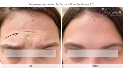 Инъекции ботокса (ботулотоксина) для коррекции морщин и лечения  гипергидроза в в клинике косметологии «Градиент» в Москве