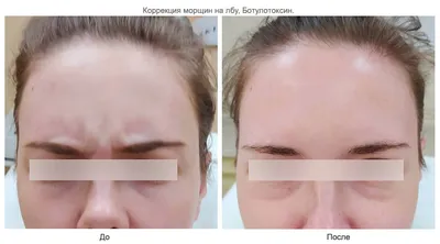 Инъекции ботокса – уколы ботулотоксина в лоб, губы и подмышки в клинике  «Вектор» в Москве