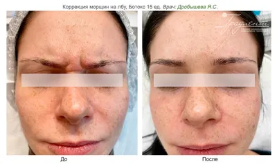 Инъекции ботокса (ботулотоксина) для коррекции морщин и лечения  гипергидроза в в клинике косметологии «Градиент» в Москве
