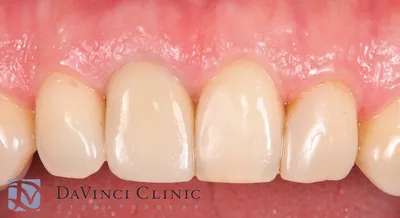 Лечение и протезирование передних зубов
