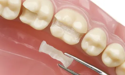 Восстановление зуба - Мир Улыбки
