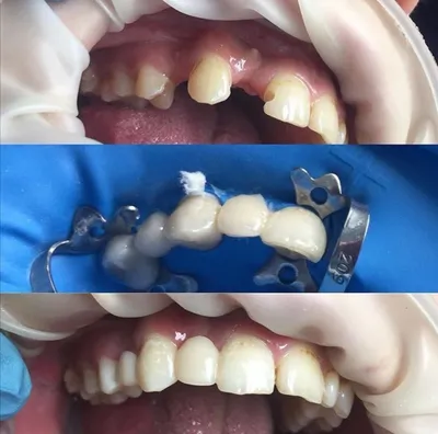Мисс стоматология - майкоп стоматология, немецкая стоматология, лечение  зубов, протезирование, профилактика и гигиена зубов, лечение десен,  отбеливание зубов - Протезирование без обточки