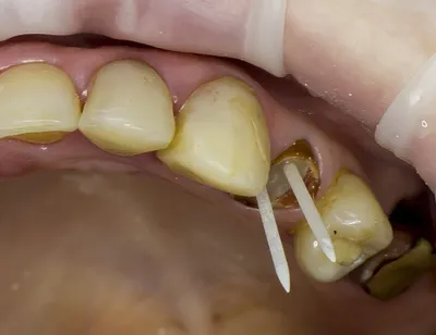 Восстановление зуба с помощью штифта - Стоматология «НоваДэнт»