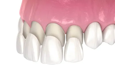 Виды художественной реставрации зубов читать в подробной статье