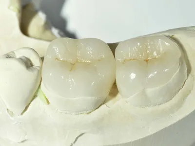 Микропротезирование зубов - СТОМАТОЛОГИЯ СТУДИЯ «ЭСТЕТ»