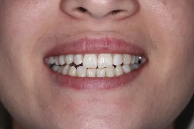 Работы врачей Династия-С: пациент Бикетова имитация зуба на мосте из  стекловолокна