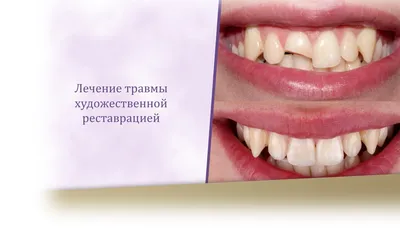Реставрация зубов в Курске. Цены на наращивание зубов в стоматологии
