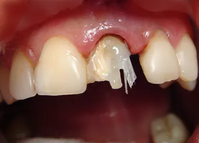 Разрушен зуб? Восстановите стекловолоконным штифтом | Стоматология  \"Имплант-Эксперт\" | Дзен