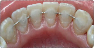 Шинирование зубов по выгодной цене: все виды протезирования в  стоматологической клинике Комплекс Дент в Киеве