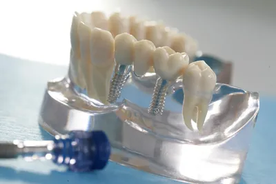 Зубы на штифте - Семейная стоматология \"Новый стандарт 32\"