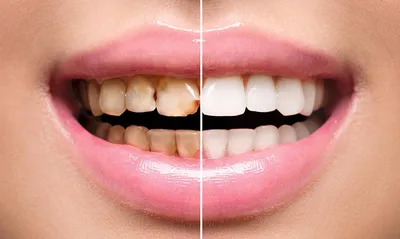 Реставрация зубов в Курске. Цены на услуги художественной реставрации зубов  в стоматологии Doctor Smile