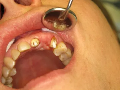 Разрушен зуб? Восстановите стекловолоконным штифтом | Стоматология  \"Имплант-Эксперт\" | Дзен