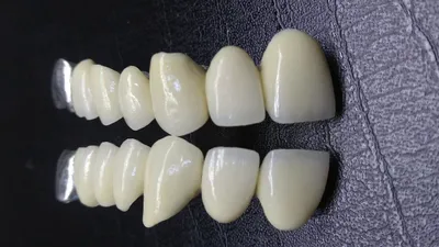 Протезирование зубов: виды, преимущества съемных и несъемных протезов ,  протезирование без обточки зуба