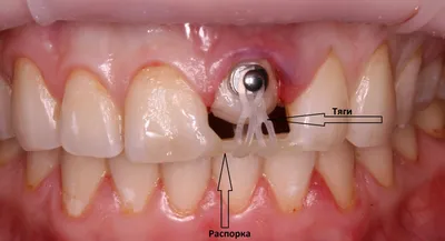 Форсированная экструзия зуба, как альтернатива имплантации. -  Стоматологическая клиника \"Стоматология МС\