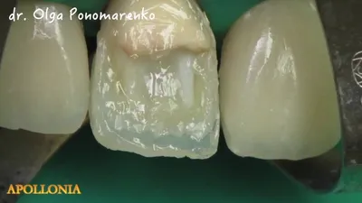 Реставрация фронтального ансамбля зубов, армирование стекловолокном -  YouTube