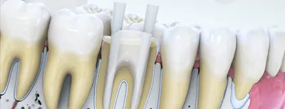 Для чего нужны стекловолоконные штифты? Стоматология Dental Way в Москве и  Московской области | Dental Way