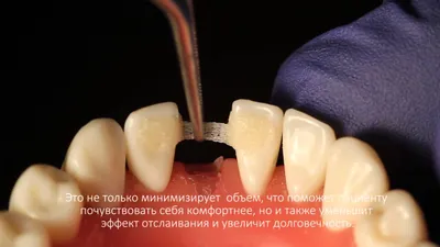 Шинирование зубов, шинирование подвижных зубов в Минске