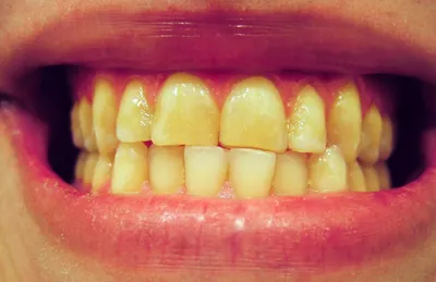 Почему желтеют зубы? | Новость