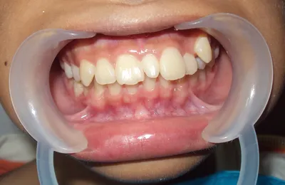 Сверхкомплектные зубы, что это такое