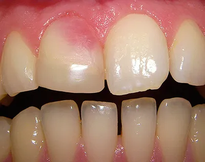 Резорциновые (розовые) зубы - Блог Маэстро