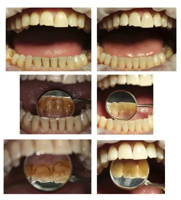 Влияние курения на зубы и десны - блог клиники Стома Сервис