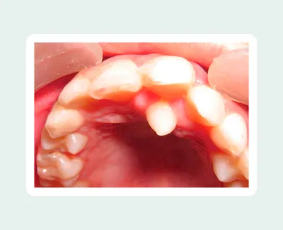 Сверхкомплектные зубы - что это, гипердонтия, причины, лечение